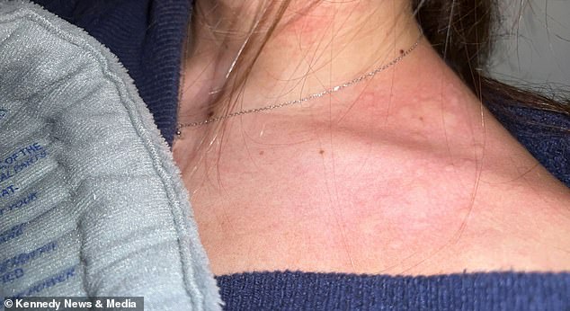 Sadowski said her initial hives were 'more like raised bumps on my back... [and] not super itchy.' However, in April 2025, she developed rashes on her shins that became extremely itchy