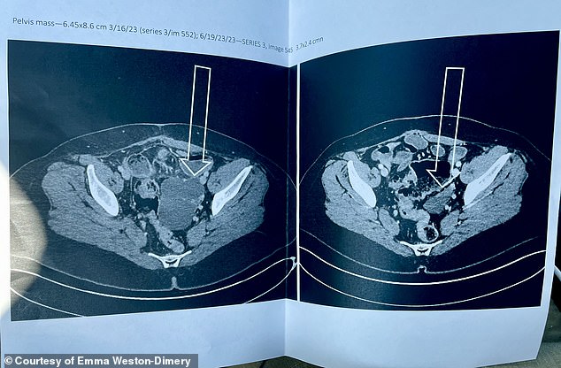 The above scan, which Weston-Dimery keeps on her refrigerator, shows the tumor on her left ovary before she received the experimental treatment and afterward