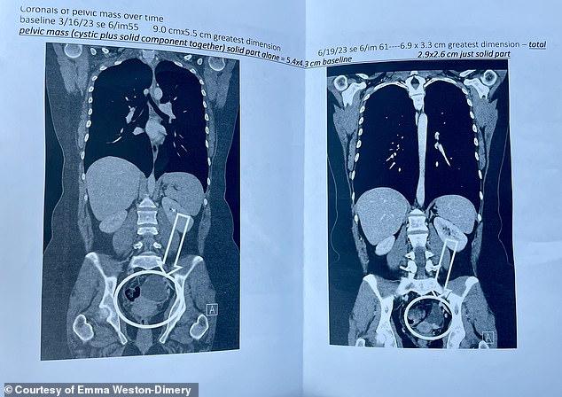 She also keeps a copy of this scan on her refrigerator, which shows the growth on her left ovary from a different angle. It shrinks following the experimental treatment