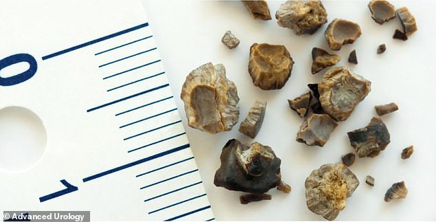 Kidney stones vary in shape, size and makeup. Calcium kidney stones, including calcium oxalate and calcium phosphate stones, are some of the most common types