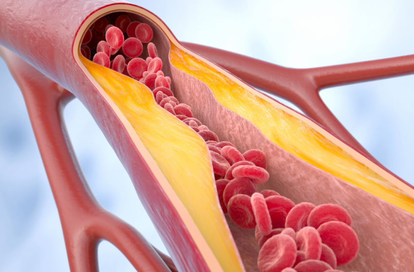  Artery ageing in your 30s? Doctors reveal early warning signs and lifestyle changes that can protect your heart