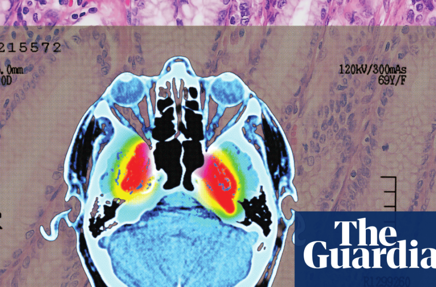  ‘Strong evidence’ of lowered dementia risk: the benefits of shingles vaccination | Well actually