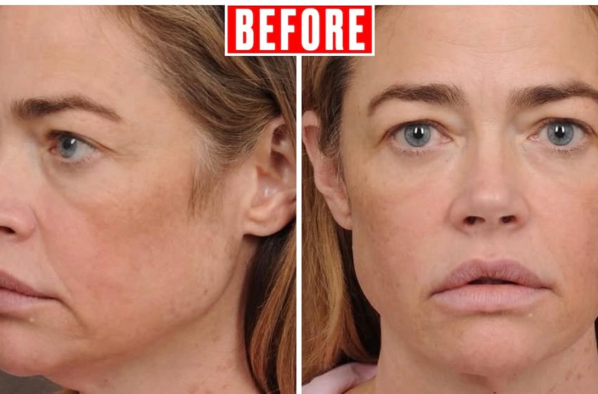  Denise Richards Posts Unreal Before and After Photos of Her Facelift