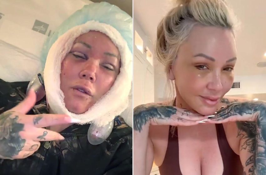  Bunnie Xo Says Her Facelift Is Making Her Feel Like She’s Being ‘Choked’ as She Details Recovery Journey
