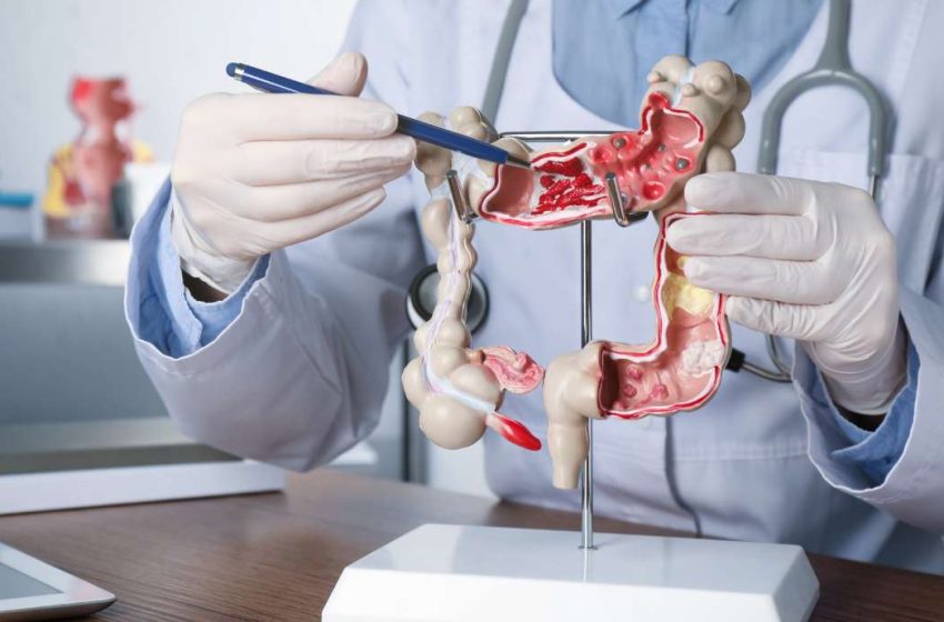  Colon cancer leading cause of cancer deaths under 50: When to see a doctor and get a colonoscopy