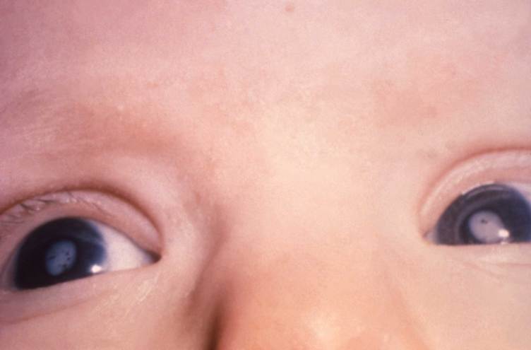Circles of white film cover the centers of a child’s eyes.