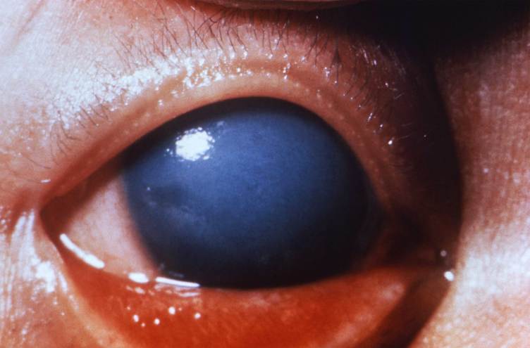 A close-up photo of a child’s eye being held open. A white film covers the entire iris so that the pupil cannot be seen.