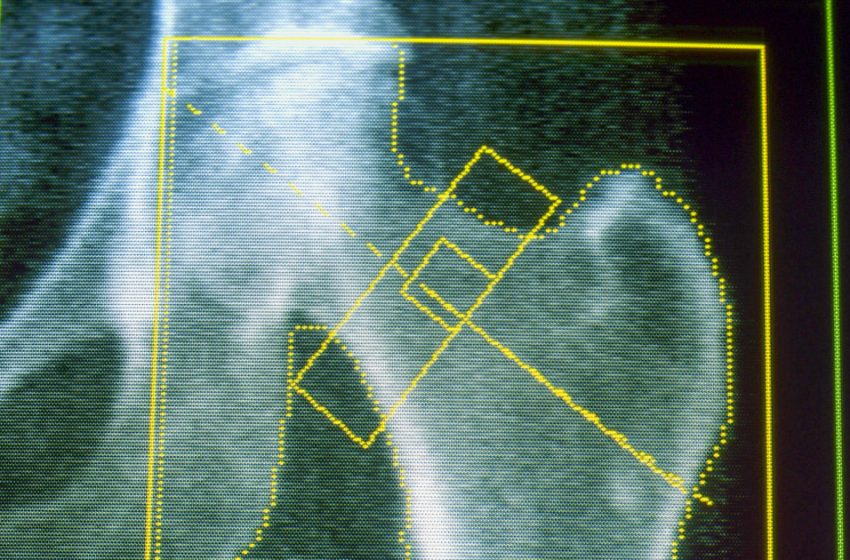  GLP-1s may increase risk of osteoporosis and gout, new research finds