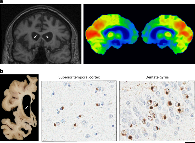  A repeat expansion in GOLGA8A is a major risk factor for atypical frontotemporal lobar degeneration with ubiquitin-positive inclusions