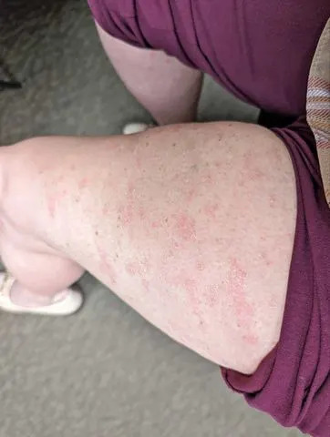 Amber Dean's legs as she suffered from plaque psoriasis.Credit: Courtesy of Amber Dean