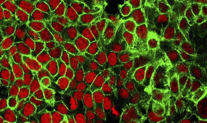  Mother warns others after stage 4 colon cancer diagnosis at 33