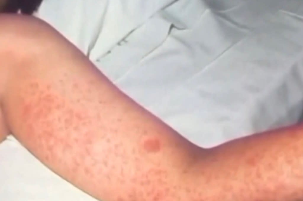 More than 100 children were potentially exposed to measles as the outbreak spreads in Sacramento County. KCRA