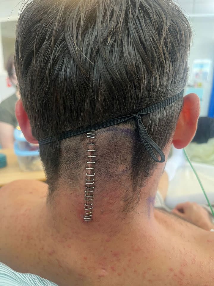 Luke Taylor after brain surgeryCredit: Nia Jones via SWNS