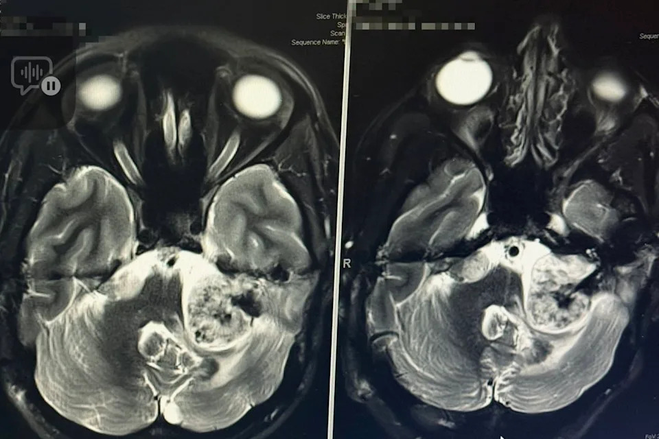 McKinnon Galloway lives with 13 tumors, including 2 in her brainCredit: McKinnon Galloway / SWNS