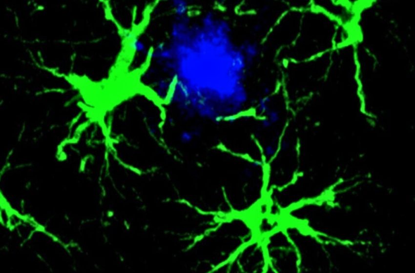  Scientists Cut Amyloid Plaques by 50% in Mice With Engineered Cells : ScienceAlert