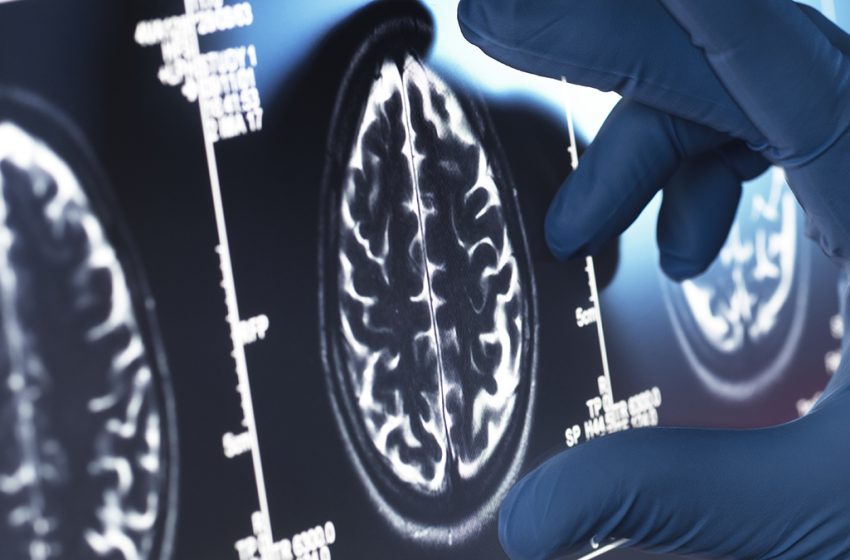  Viagra May Be One of Our Best Existing Options For an Alzheimer’s Treatment : ScienceAlert