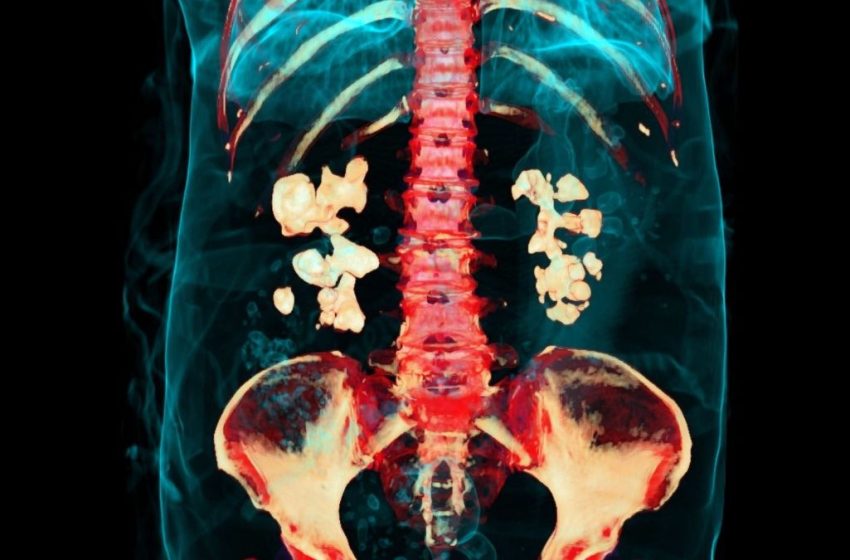  Bacteria Play Previously Unknown Role in Kidney Stones, Study Finds : ScienceAlert