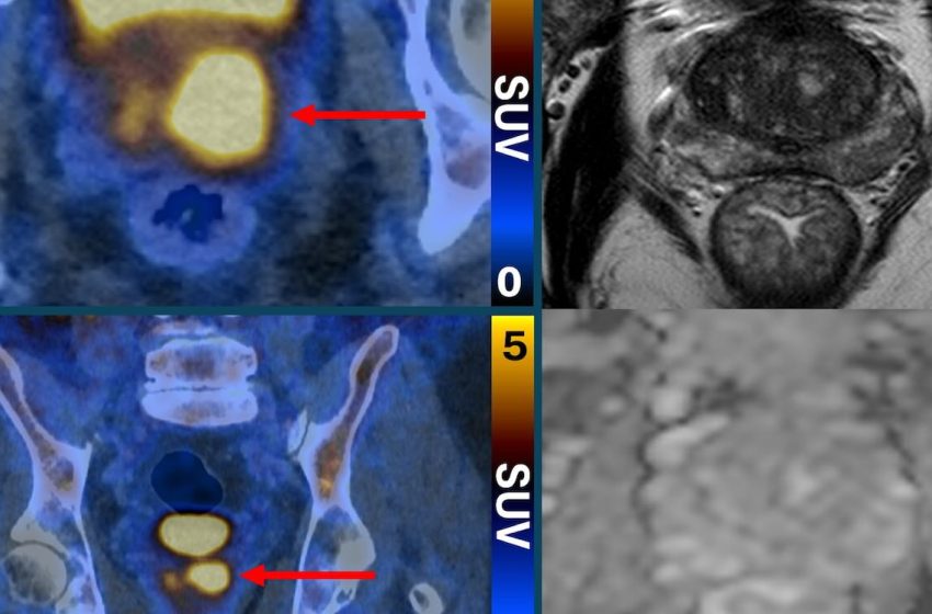  Scans That Make Prostate Cancer Cells ‘Glow’ Can Eliminate Invasive Biopsies and False Diagnoses