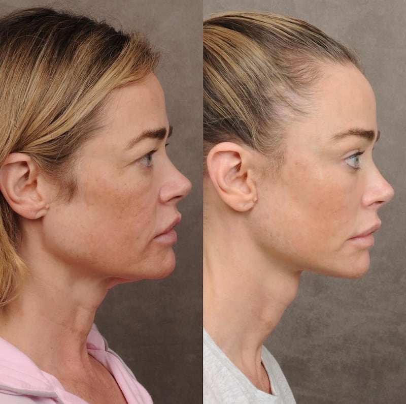 Denise Richards facelift