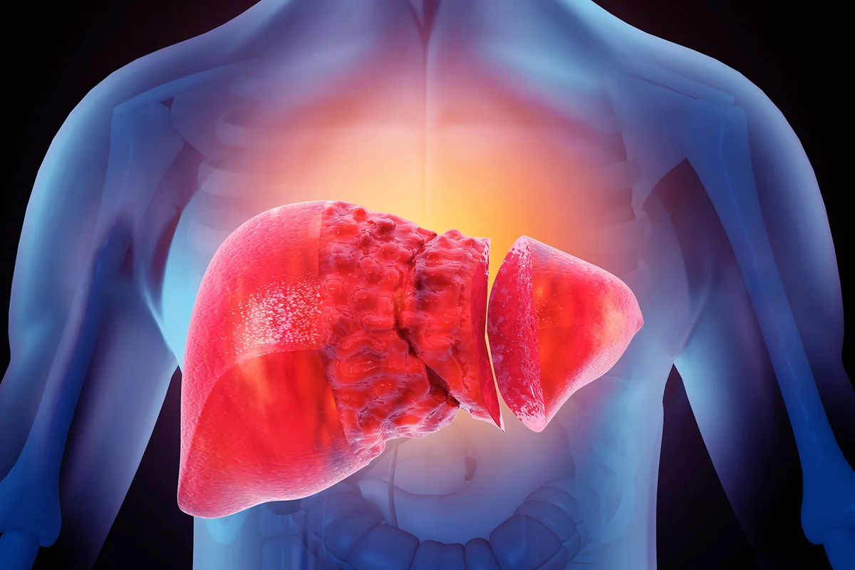 A damaged liver inside a human body