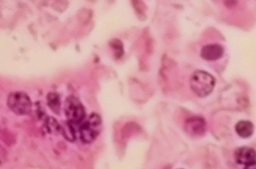  Measles outbreak in Michigan county as cases spread ‘like wildfire’