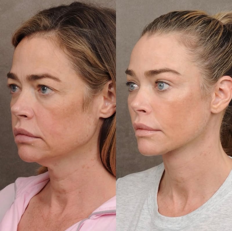Denise Richards facelift