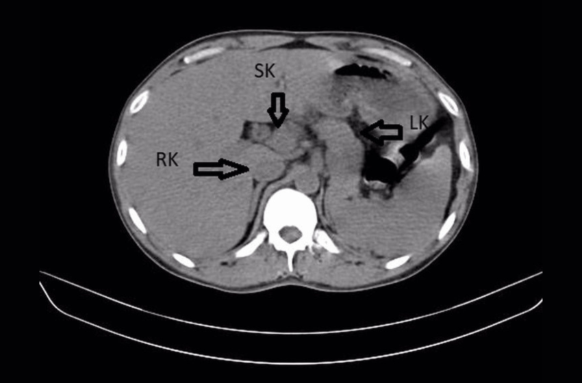 Diagnostic dilemma: A man’s back pain led to the discovery of a third kidney