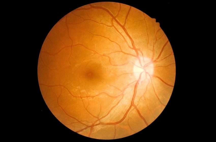  What Is ‘Eye Stroke’? Expert Explains The Rare Wegovy Risk : ScienceAlert