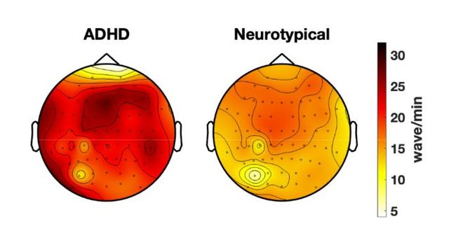  ADHD Inattention Tied to Sleep-Like Brain Waves