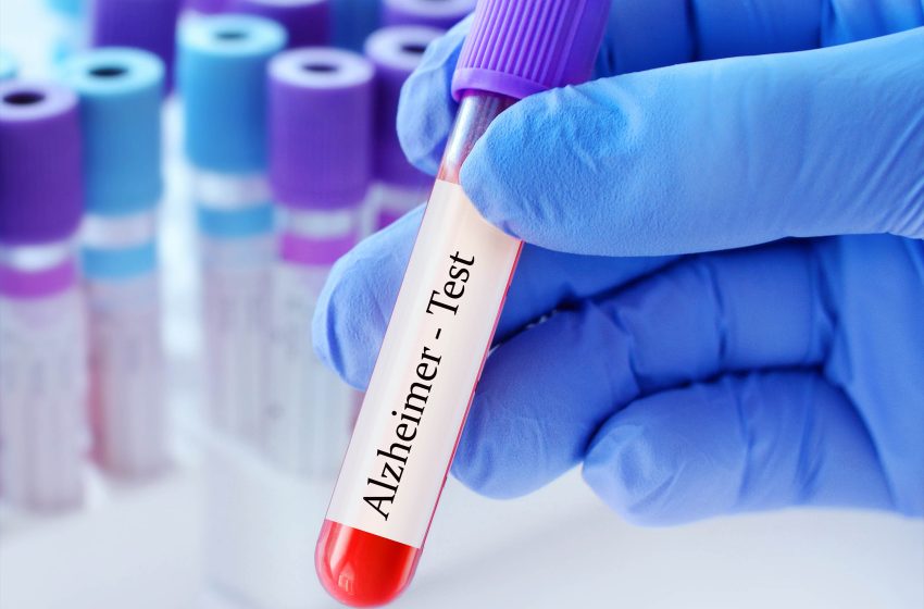  Blood test predicts dementia 25 years before symptoms appear