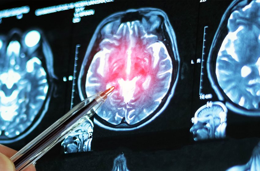  Experimental drug restores memory loss caused by Alzheimer’s