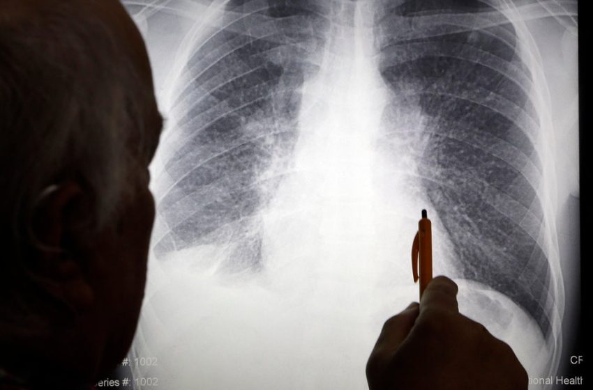  Silicosis, lung disease once linked to mining, hits workers in countertops industry