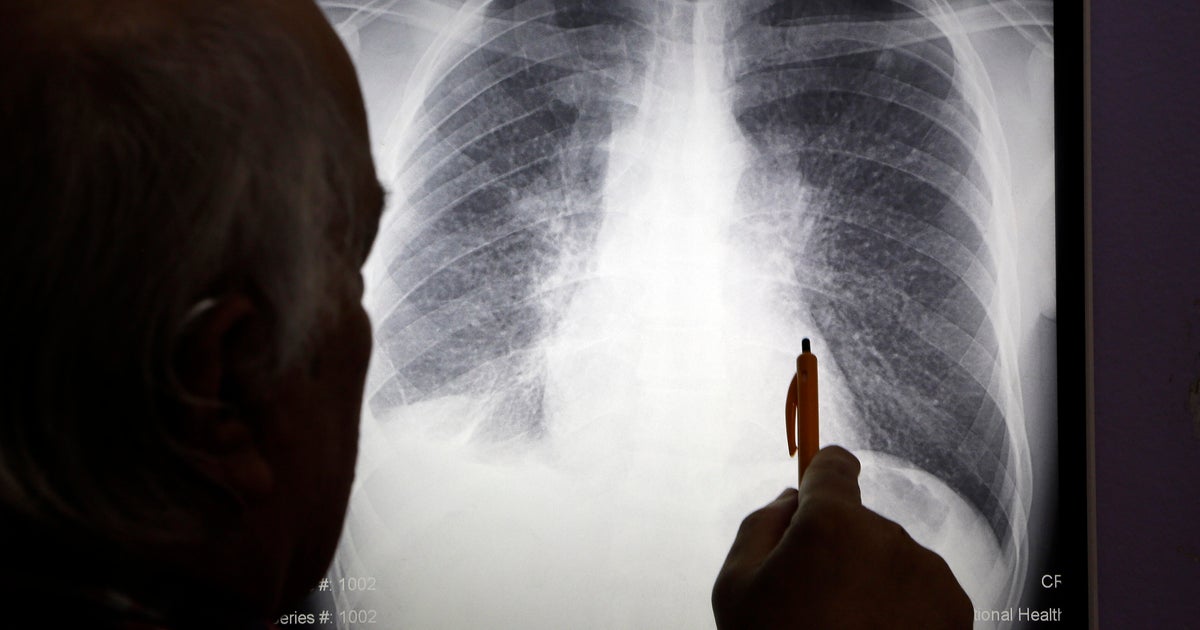 Doctor looks at an X-ray of a patient's lungs 