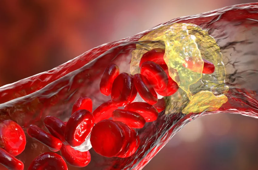  Powerful cholesterol drug cuts heart attack risk by 31%