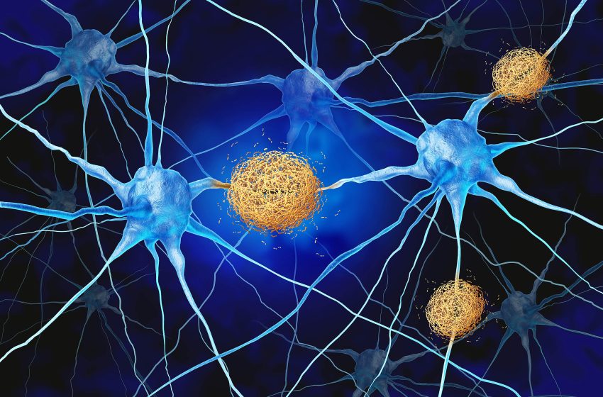  Normal brain immune cells may actually be causing Alzheimer’s