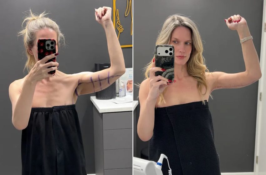  Woman, 41, Was Tired of ‘Hiding’ Excess Skin After Losing 180 Lbs. on a GLP-1. Then She Got an ‘Awake’ Arm Lift (Exclusive)