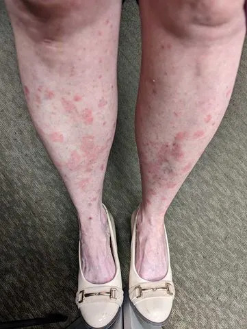 Amber Dean's legs as she suffered from plaque psoriasis.Credit: Courtesy of Amber Dean