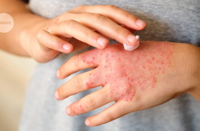  Stress can cause eczema to flare-up – now we know why