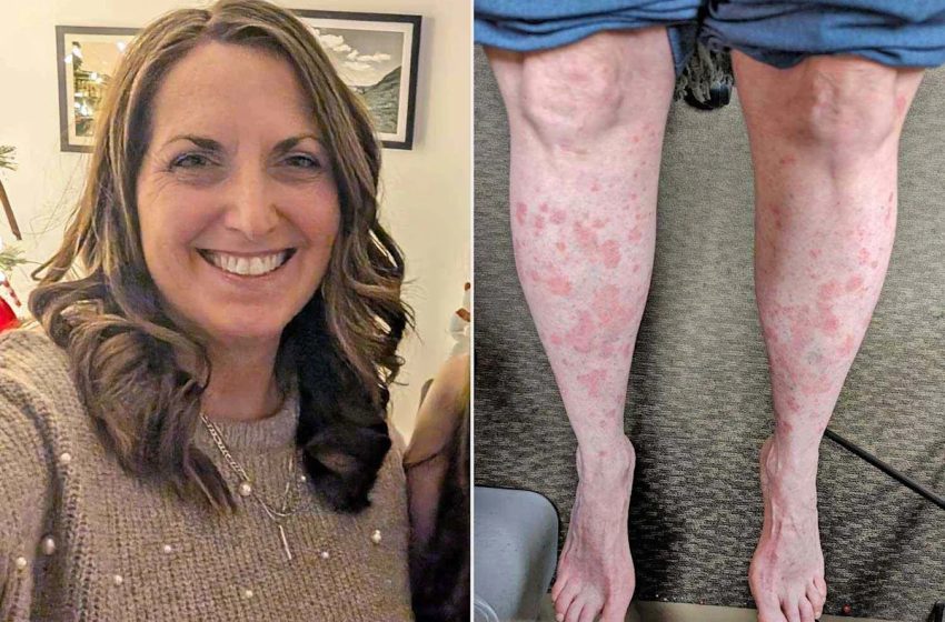  Woman, 47, Suffered Physically and Emotionally for Years from Psoriasis. Then, One Decision Changed Everything (Exclusive)