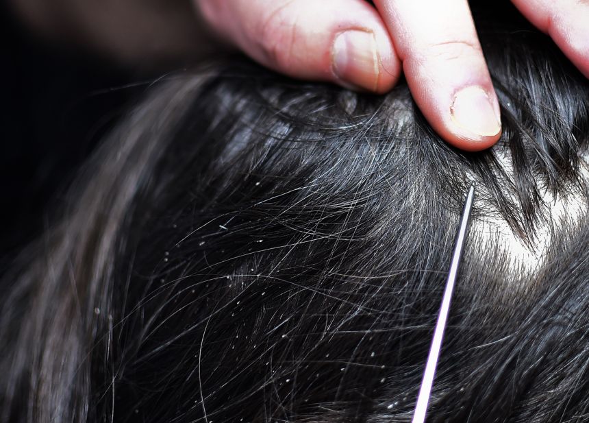 Head lice are pests that have plagued humans for thousands of years.