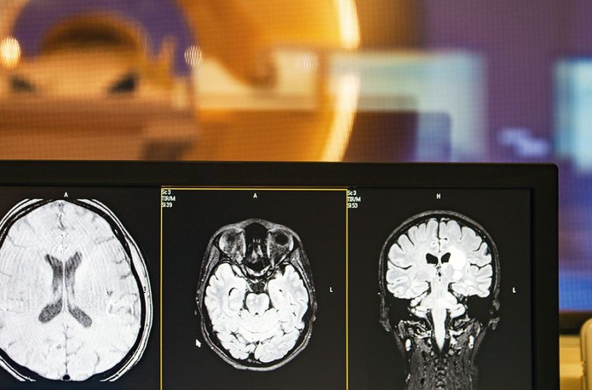  Gut microbiome may drive memory loss via vagus nerve