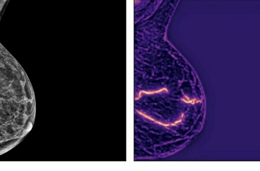  Significant Heart Disease Risk Can Be Detected from Routine Mammograms Using AI – Up to 70% Greater