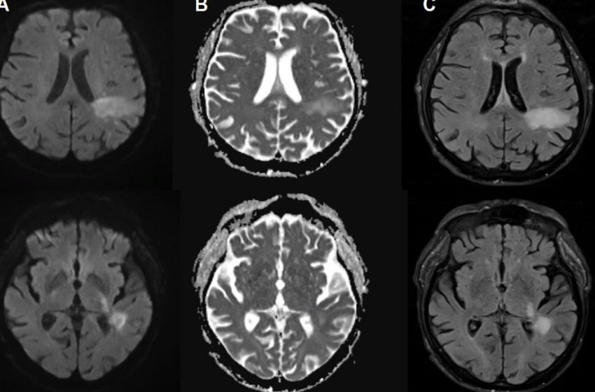  You’re likely already infected with a brain-eating virus you’ve never heard of