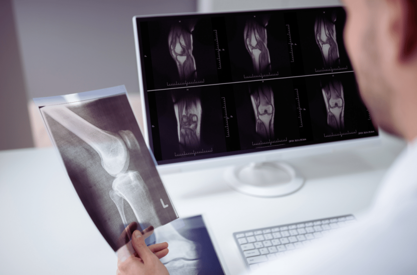  Scientists Discover Breakthrough That May Reverse Osteoporosis and Strengthen Bones