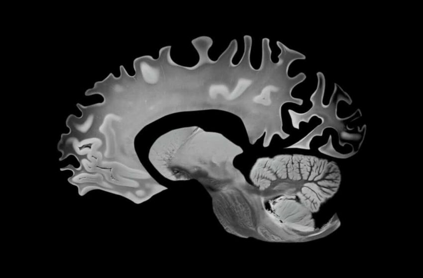  This “Hybrid” Diet Doesn’t Just Protect Your Heart, It’s Slowing Brain Aging Too