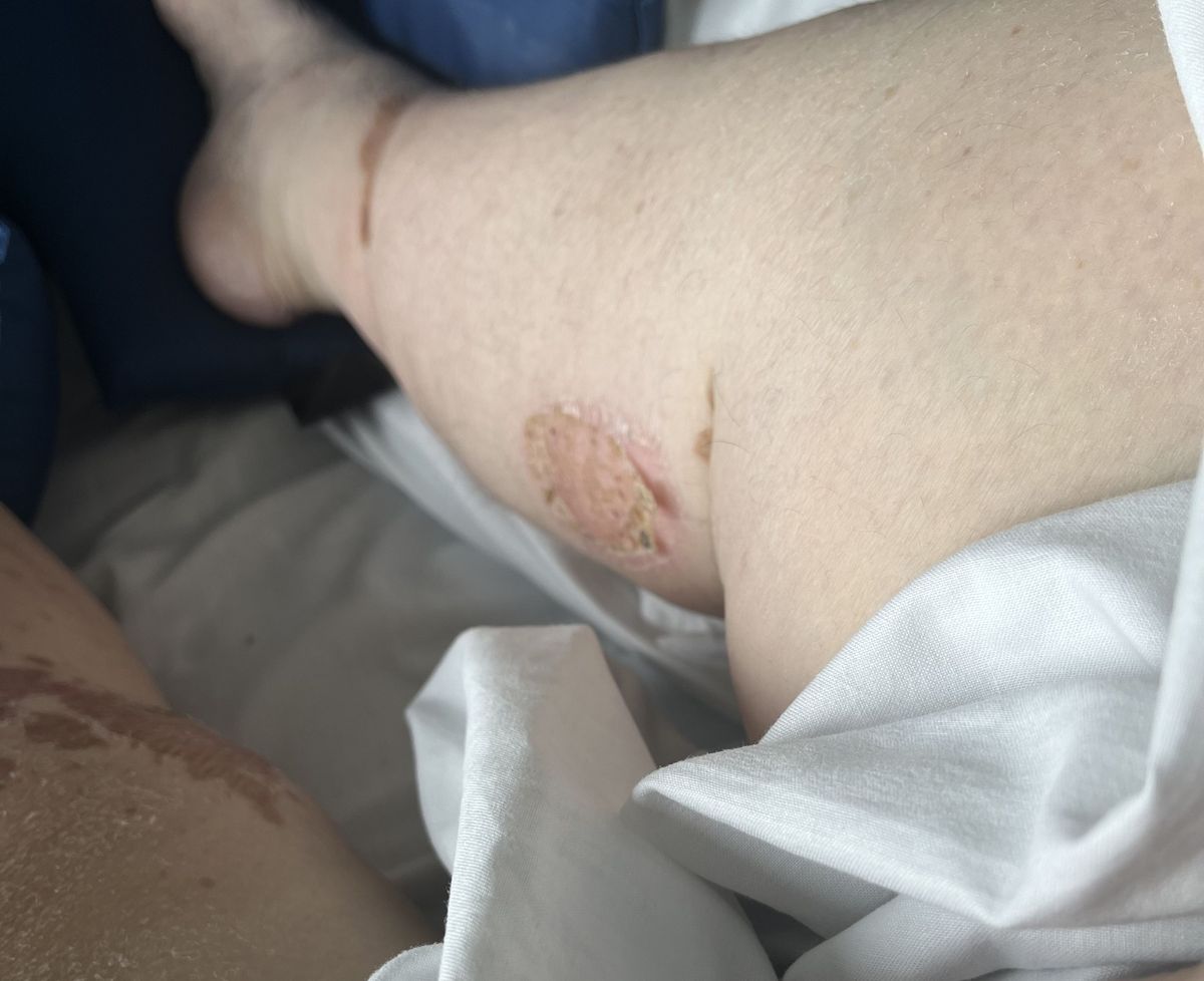 More sores on one of Carol's legs