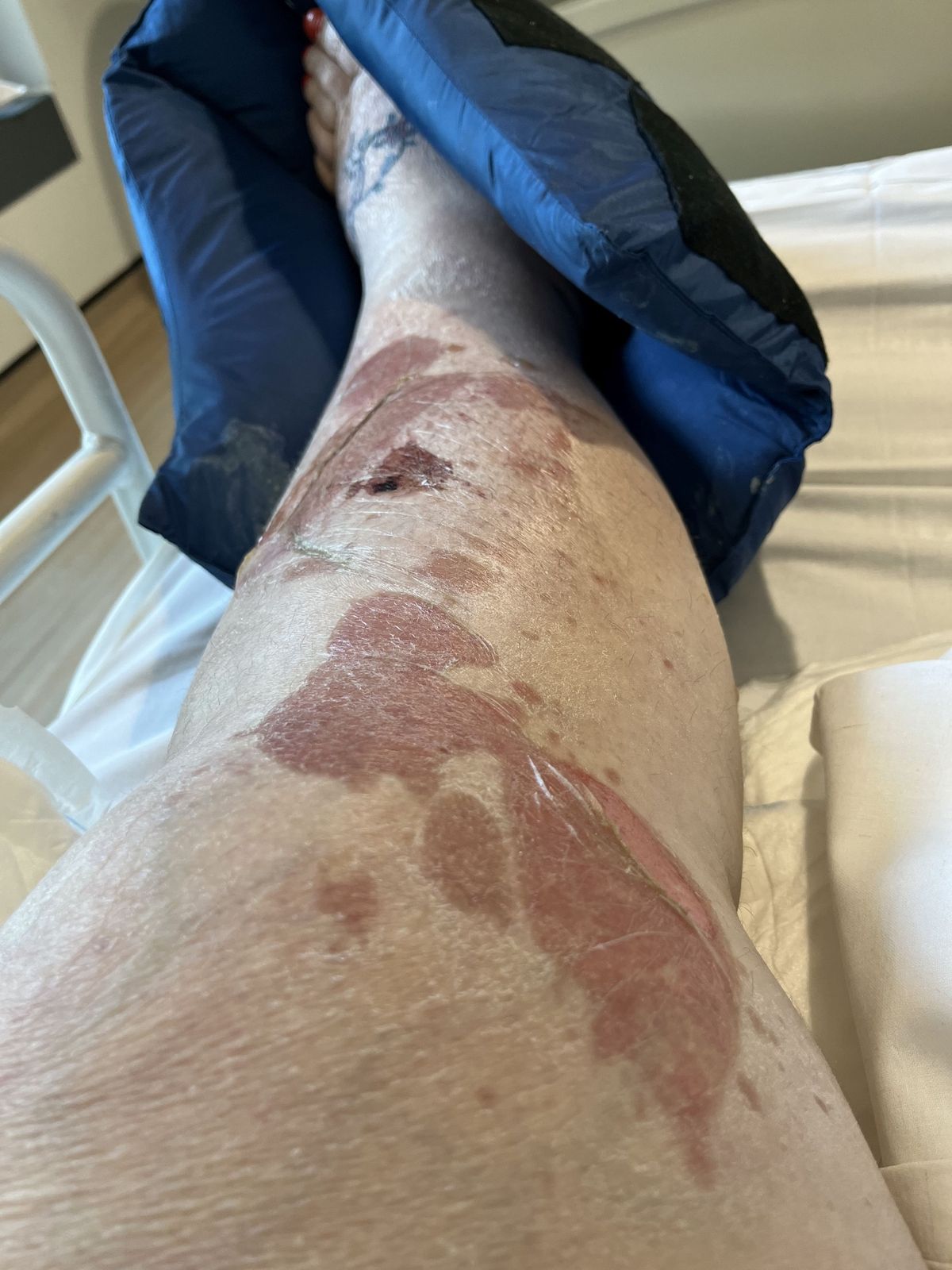 Carol's leg covered in sores