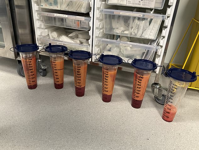 The painful fat removed during Ellie's procedure