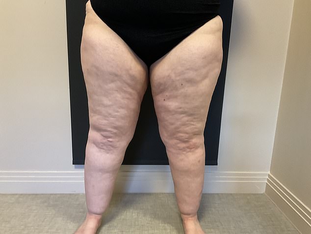 Patients often describe the fat as appearing and feeling painful, spongey or nodular