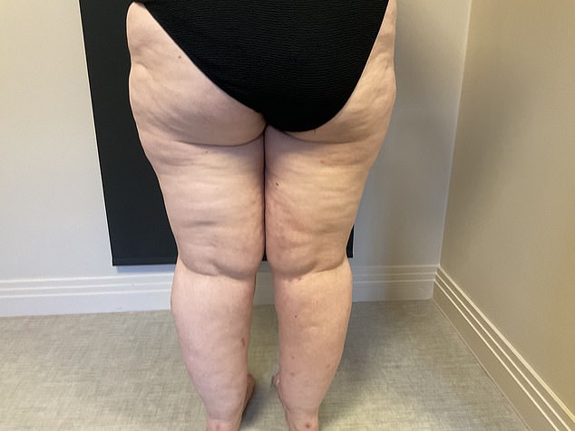 Lipoedema is a condition that causes an abnormal distribution of fat